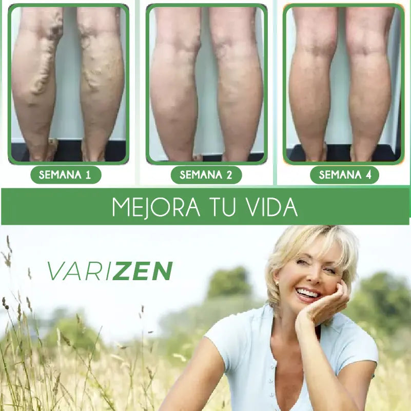 CREMA ANTI VARICES VARIZEN [PV1-WHATSAPP-MEGAOFERTAPLUS]